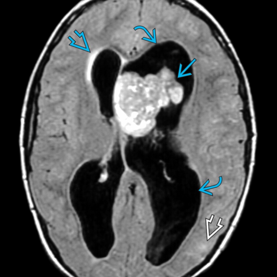 Axial FLAIR MR in a patient with tuberous sclerosis shows large subependymal giant cell astrocytoma  causing obstructive hydrocephalus  with mild periventricular edema . Note the subtle hyperintensity in the occipital lobe tuber .