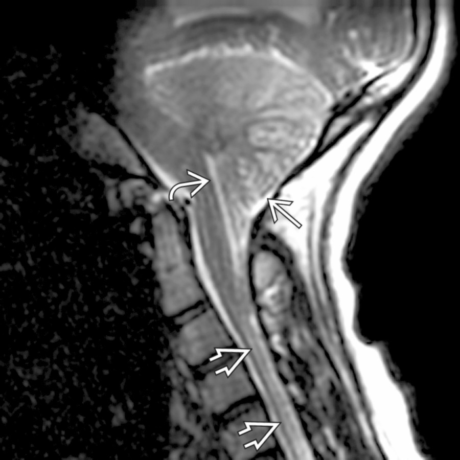 Sagittal T2WI MR shows a small posterior fossa with caudal descent of cerebellar tonsillar tissue , elongation of the 4th ventricle , and cervical cord syrinx .