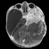 Axial T1 C+ MR shows a large, enhancing mass in a temporal off-midline location  in a neonate with maximal hydrocephalus and layering blood products  as well as cellular debris .