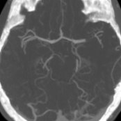 Axial CTA MIP in a 14-year-old with right-sided weakness and history of congenital heart disease shows abrupt cutoff  of the M1 segment of the left middle cerebral artery (MCA). MIP imaging is particularly helpful to identify vessel occlusion in stroke. This patient was treated with catheter-directed thrombectomy.