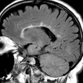 Sagittal FLAIR shows callososeptal hyperintensities  radiating from the lateral ventricles with a typical perpendicular orientation, characteristic of MS.