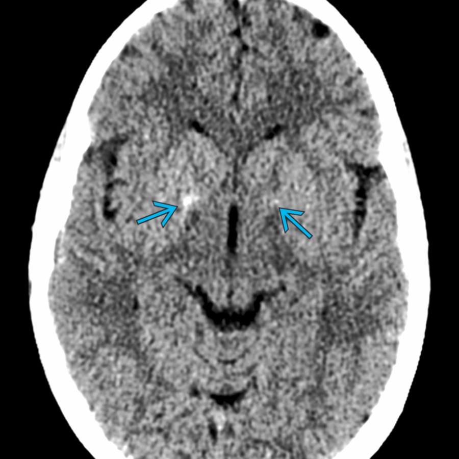 Axial NECT shows globus pallidus mineralization bilaterally  in a patient with pantothenate kinase-associated neurodegeneration. CT is typically normal. T2 MR shows classic the eye of the tiger appearance with globus pallidus hypointensity related to iron accumulation with medial T2 hyperintensity.