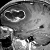 Sagittal T1 C+ MR in a patient treated for sinusitis who presented with headache, fever, and seizures shows a large, ring-enhancing abscess  with an eccentric nodule . DWI (not shown) showed characteristic diffusion restriction in the central nonenhancing component.