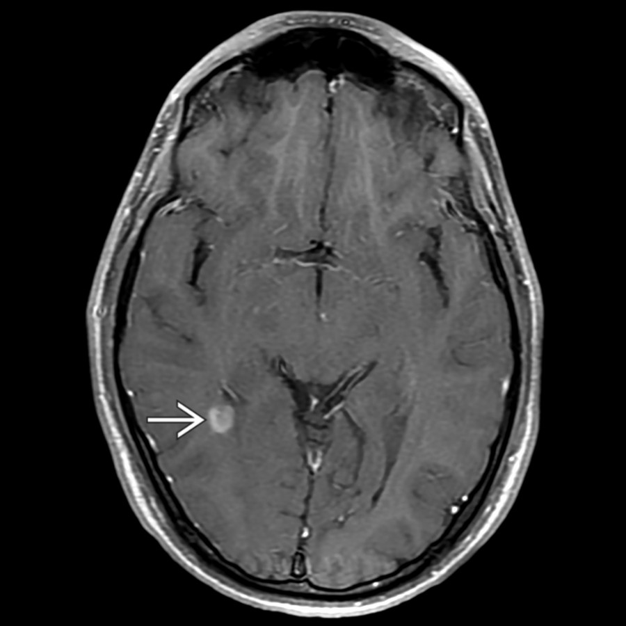 Axial T1 C+ FS MR in the same patient  confirms abnormal peripheral lesion enhancement with an incomplete ring pattern .