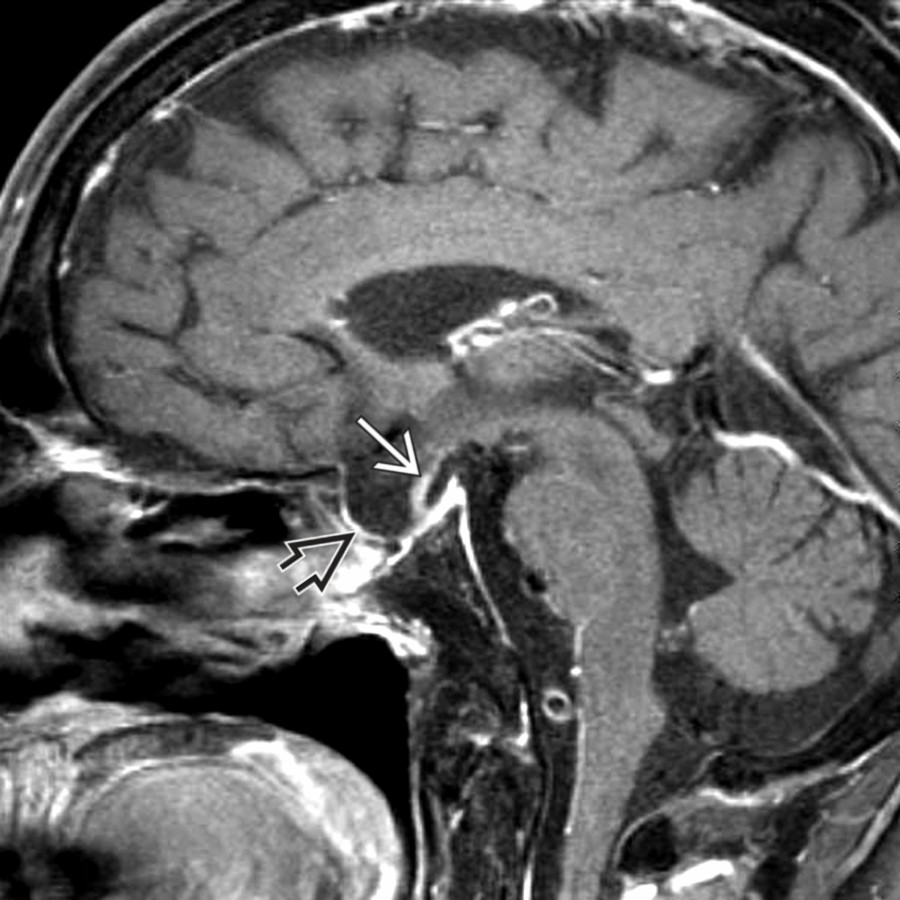 Sagittal T1 C+ FS MR following transsphenoidal hypophysectomy shows that the thinned stalk  is stretched and retracted inferiorly into the partially empty sella .