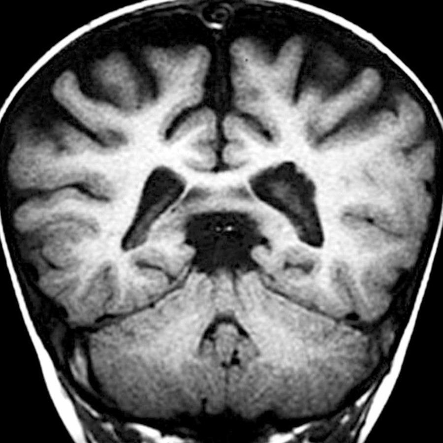Coronal T1WI MR in a toddler with rapid head growth for 4 months shows enlarged ventricular trigone on the left and enlarging subarachnoid spaces at an age when they should be shrinking. MR venography showed occlusion of both transverse sinuses.