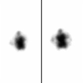 24-hour axial SPECT in the same patient demonstrates marked ventricle activity , confirming the presence of NPH.