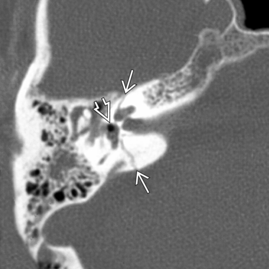 Axial bone CT reveals a transverse fracture traversing the inner ear structures , crossing obliquely from just anterior to the vestibular aqueduct to the vestibule and then anterolaterally to cross the cochlea. Notice the pneumolabyrinth  in the vestibule indicating a perilymphatic fistula at the oval window level.