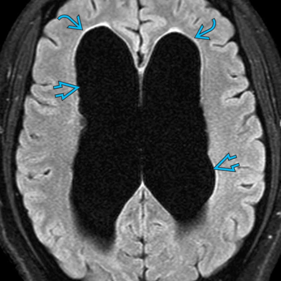 Axial FLAIR MR in the same patient shows marked enlarged lateral ventricles  with a very thin periventricular hyperintense rim  and no sulcal effacement due to chronic compensated IVOH.