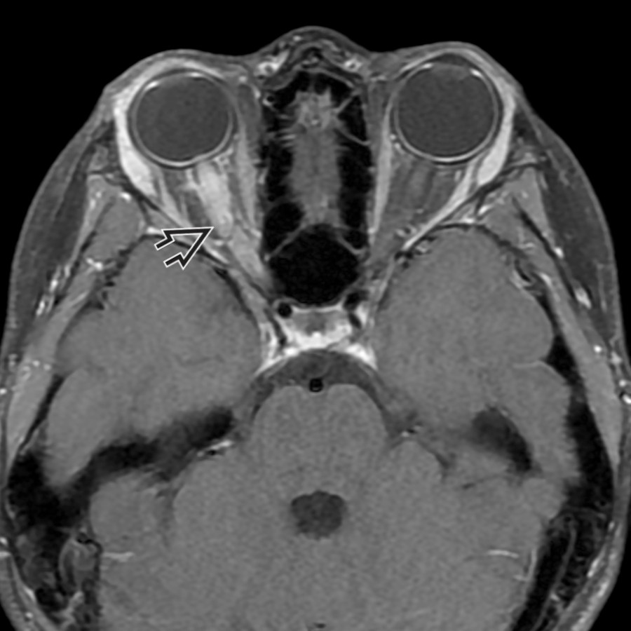 Axial T1 C+ FS MR in the same patient 3 months prior reveals avid contrast enhancement of the left optic nerve (anterior segment) . Laboratory assessment at that time confirmed MOG antibodies, but brain imaging was normal (not shown).