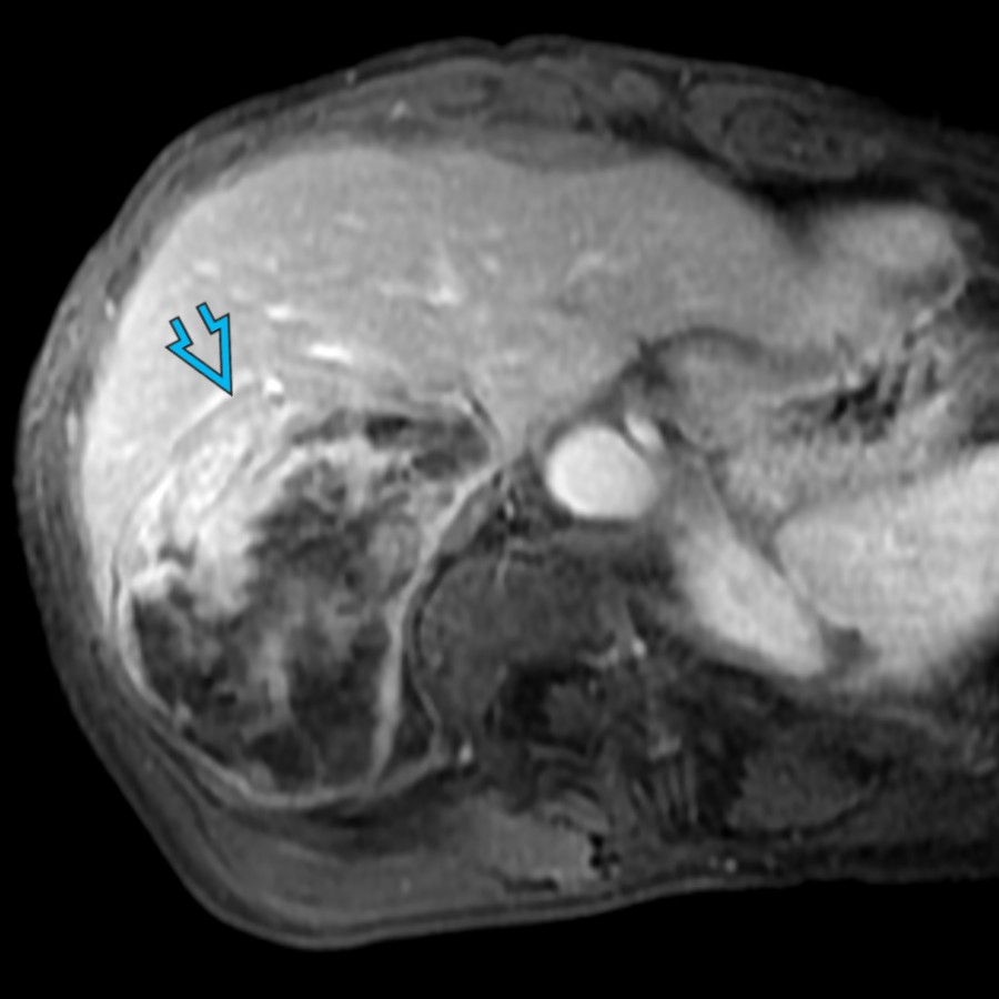Axial T1 FS C+ MR in the same patient shows heterogeneous enhancement of the surgically proven pheochromocytoma . The patient was treated with alpha-blockade (phenoxybenzamine) for 1 month prior to intervention.