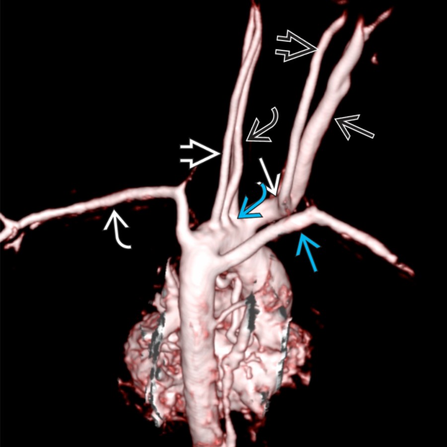 MRA 3D posterior oblique view shows 6 branches from the aortic arch. From proximal to distal the branches are: A common trunk  dividing into right common carotid artery  and right vertebral artery , left internal carotid artery , left external carotid artery , left vertebral artery , left subclavian artery , and ARSA  .