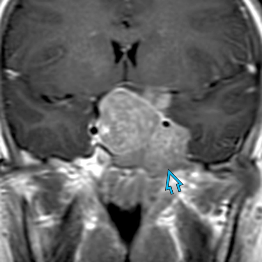Coronal T1 C+ MR in the same patient shows homogeneous enhancement of the mass. There is involvement of the adjacent skull base , and the pituitary gland was not seen separate from the mass. These findings are typical of a giant pituitary macroadenoma.