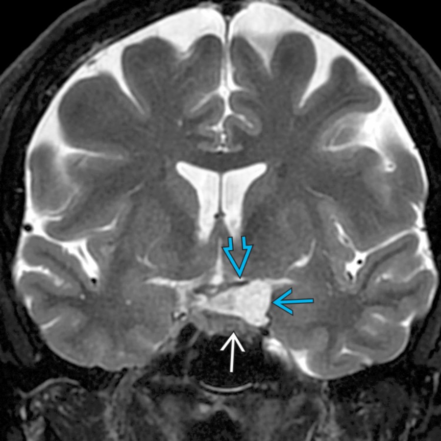 Coronal T2WI MR shows an epidermoid cyst in the left suprasellar cistern  with mass effect on the optic chiasm  superiorly and the pituitary gland    inferiorly. These benign cysts classically show restricted diffusion and lack suppression on FLAIR sequences. Surgical resection is the treatment of choice.
