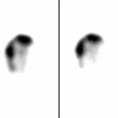24-hour transaxial SPECT in the same patient confirms no ventricular activity. Mild asymmetry to flow over convexities is present and can be normal.