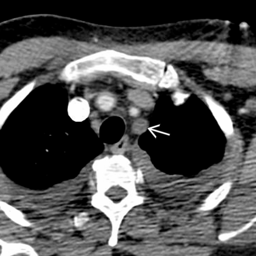 Axial CECT in a patient with TA shows soft tissue attenuation and no contrast opacification within the left subclavian artery , consistent with occlusion.