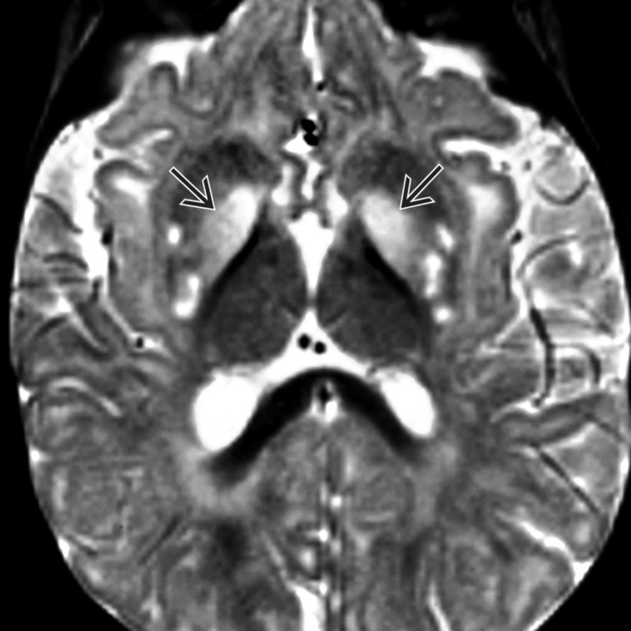 Axial T2WI MR shows symmetric T2 hyperintensity in the BG  bilaterally in this child with neurodegeneration. Ca⁺⁺ of the BG is seen in chronic cases.