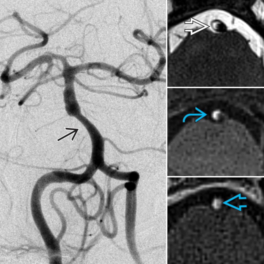DSA shows ~ 50% narrowing of the midbasilar artery  in a patient with a pontine infarct. T2-hyperintense plaque  on vwMR, IPH on MPRAGE , and wall enhancement  on DANTE T1 SPACE indicate active plaque.