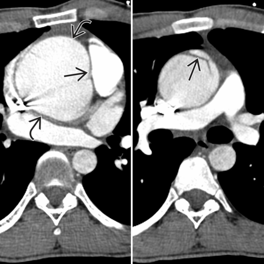 Axial CECT in the same patient shows marked aortic root dilatation . Note disproportion in the diameter of the pulmonary trunk, which should typically be the same size as the ascending aorta. At the higher level, there is an intimomedial defect representing ascending aortic dissection .
