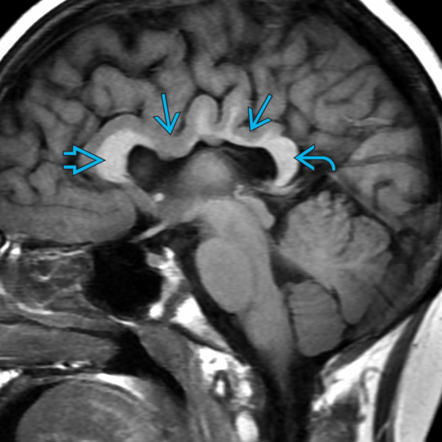 Midline sagittal T1 MR in a teenager with the middle interhemispheric variant of holoprosencephaly shows an intact CC anteriorly  & posteriorly  but abnormal extension of GM  across the midline in the expected location of the CC body. The abnormal body of the CC typically "dips" down toward the interthalamic adhesion.