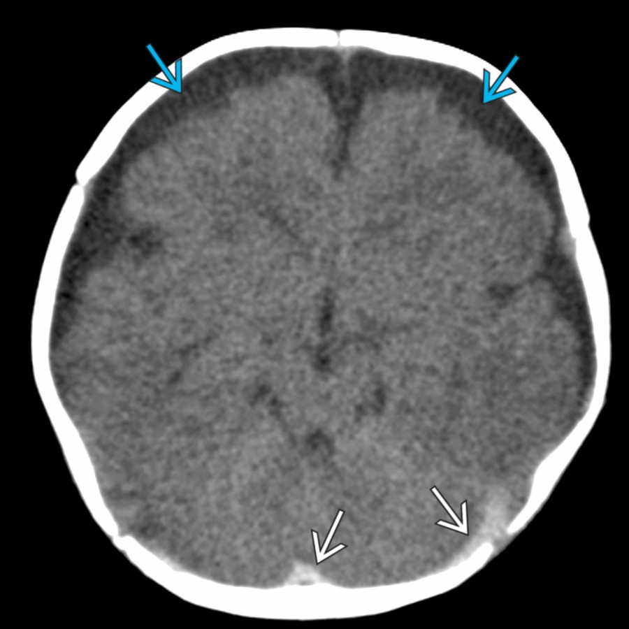 Axial NECT in the same patient 3 days later shows more conspicuous layering of a SDH  in the posterior fossa. Also note the significant enlargement of the low-attenuation extraaxial collections , most of which are nonhemorrhagic & isodense to CSF, consistent with enlarging subdural hygromas (SDHy). As illustrated by this case, it is impossible to say that a predominantly nonhemorrhagic collection with a small amount of acute SDH is an "acute-on-chronic" SDH. Rather, when such an appearance is encountered on initial imaging, it is more likely an acute mixed SDH/SDHy.