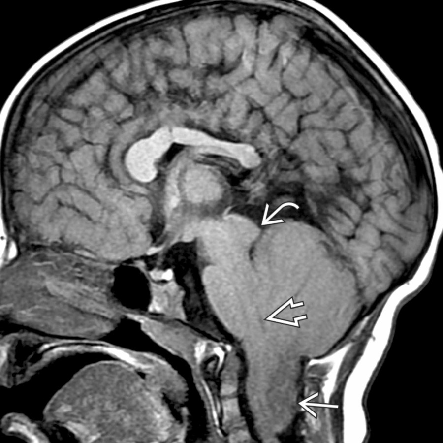 Sagittal T1WI MR shows a small posterior fossa with extension of the cerebellar peg  through the foramen magnum to the level of C3. The cervicomedullary junction and 4th ventricle  are low-lying, and there is tectal beaking .