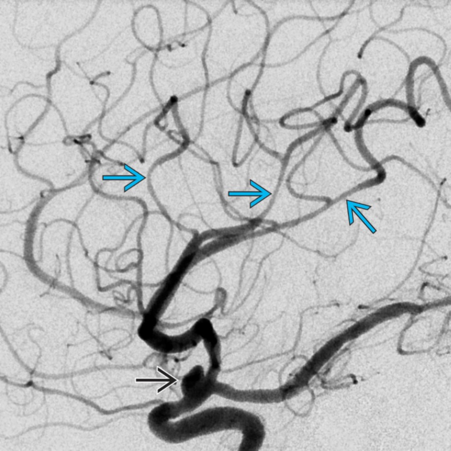 In a patient with a ruptured pseudoaneurysm , DSA shows multifocal areas of vessel narrowing, consistent with vasospasm . vwMR was negative in the areas of narrowing (not shown).