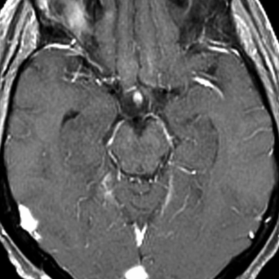 Axial T1 C+ MR in the same patient shows no significant enhancement in the medial temporal lobes. Enhancement is often present in limbic encephalitis. The patient's symptoms often improve after treatment of the primary tumor.