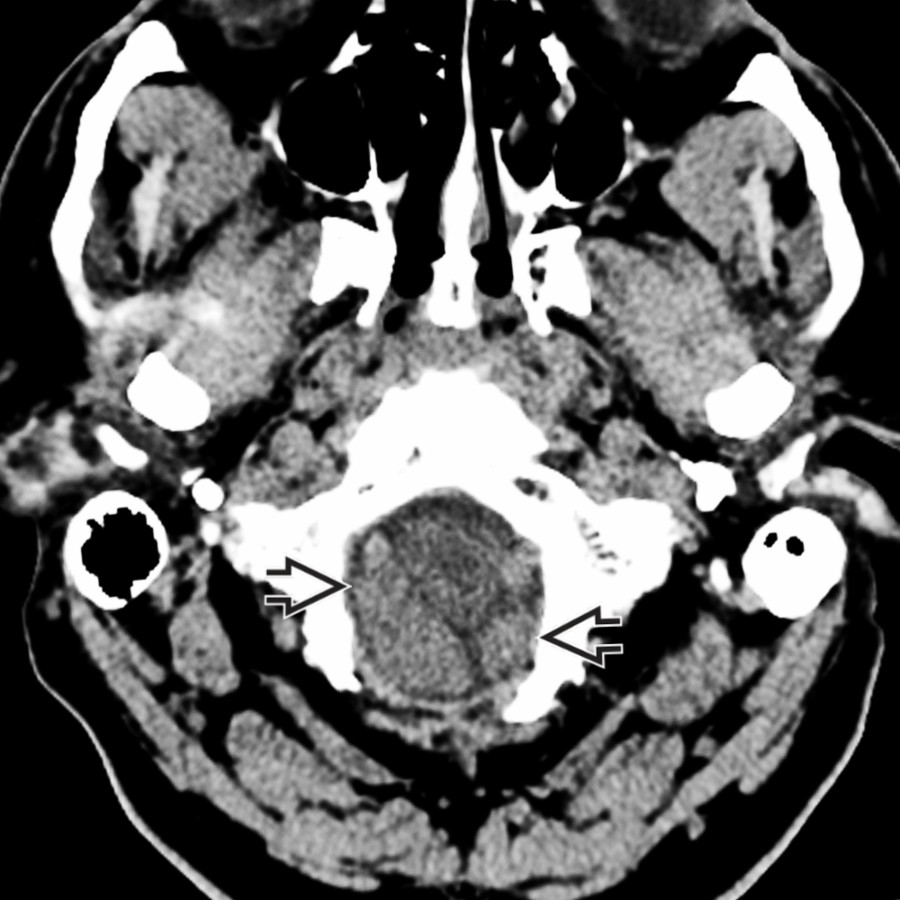 Axial NECT in a 55-year-old man with a severe headache in the ER shows downward herniation of both cerebellar tonsils  through the foramen magnum.