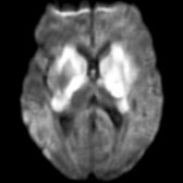 Axial DWI MR confirms the rare manifestation of ADEM, displaying bilateral striatal necrosis, as evidenced by asymmetric confluent restricted diffusion involving gray and white matter of bilateral corpus striatum.