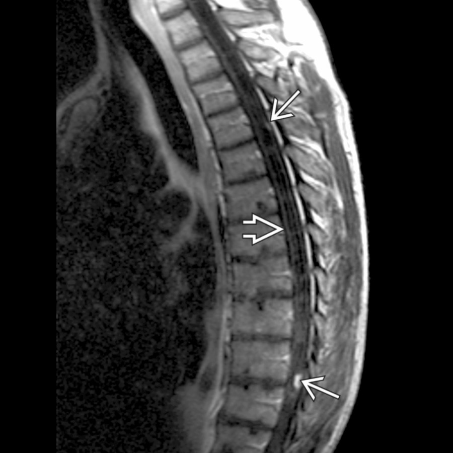 Sagittal T1 C+ MR shows holocord syrinx  and 2 small dorsal enhancing lesions  in this patient with multiple hemangioblastomas.