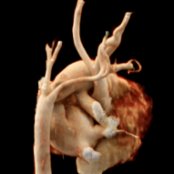 Posterior oblique CTA cinematic rendering shows type B interrupted aortic arch  with an aberrant right subclavian artery . Also note the collateral vessel  with right carotid artery . Left carotid artery  and left subclavian artery (LSA)  are also shown.