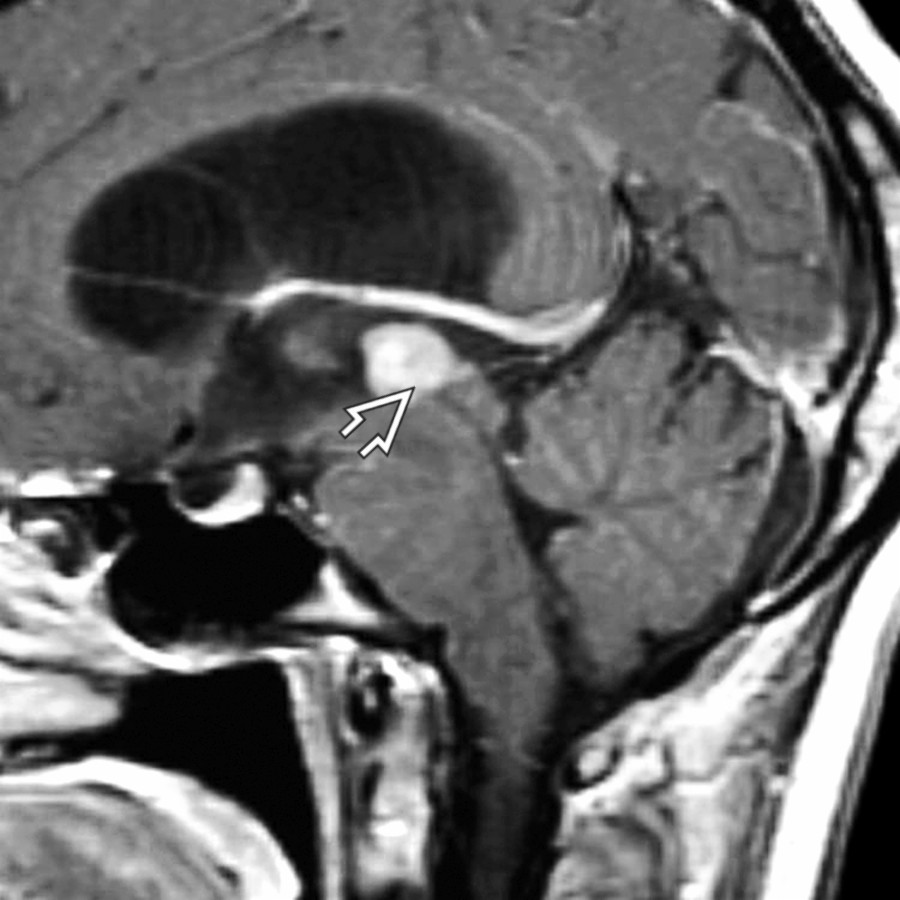 Sagittal T1 C+ MR shows a homogeneously enhancing mass in the posterior 3rd ventricle , which causes obstruction and dilatation of the lateral and 3rd ventricles. On pathology, this was an astrocytoma.