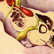 Axial graphic of a larger facial nerve schwannoma (FNS) shows cerebellopontine angle (CPA) ("ice cream")  & internal auditory canal (IAC) ("cone")  components that mimic a vestibular schwannoma. The labyrinthine segment of facial nerve involvement  makes the diagnosis.