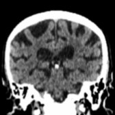 Coronal CT in the same patient shows significant areas of brain atrophy , accounting for areas that may appear to be negative for gray matter Aβ deposition but in reality represent areas of significant neurodegeneration. This underlines the importance of looking at the correlative imaging in addition to the qualitative or quantitative PET imaging.