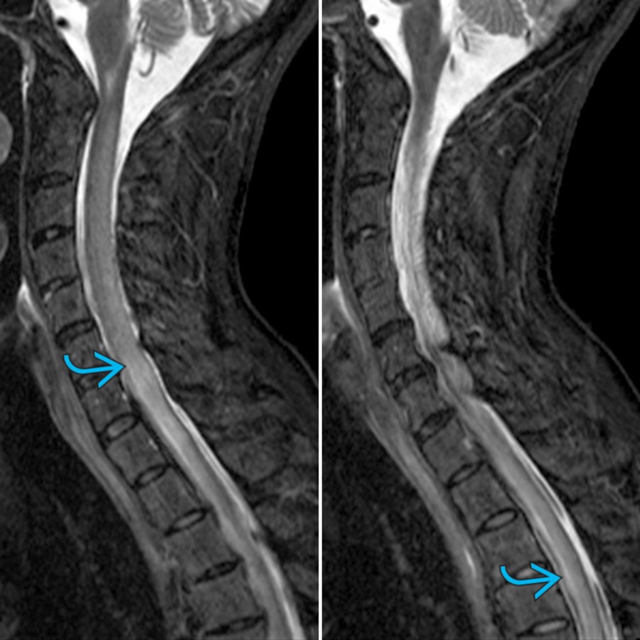 Sagittal STIR MR in a patient presenting with myelopathy demonstrates a long segment of cord enlargement with hyperintensity .