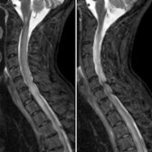 Sagittal STIR MR in a patient presenting with myelopathy demonstrates a long segment of cord enlargement with hyperintensity .