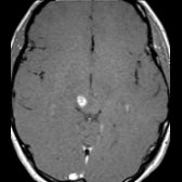 Axial T1 C+ MR in the same patient shows a well-defined nodular area of enhancement  in the region of FLAIR signal abnormality. Most reported NMO brain lesions do not show enhancement. The enhancement patterns reported include patchy enhancement with blurred margins ("cloud-like" enhancement), "pencil-thin" ependymal enhancement, and solid enhancement.