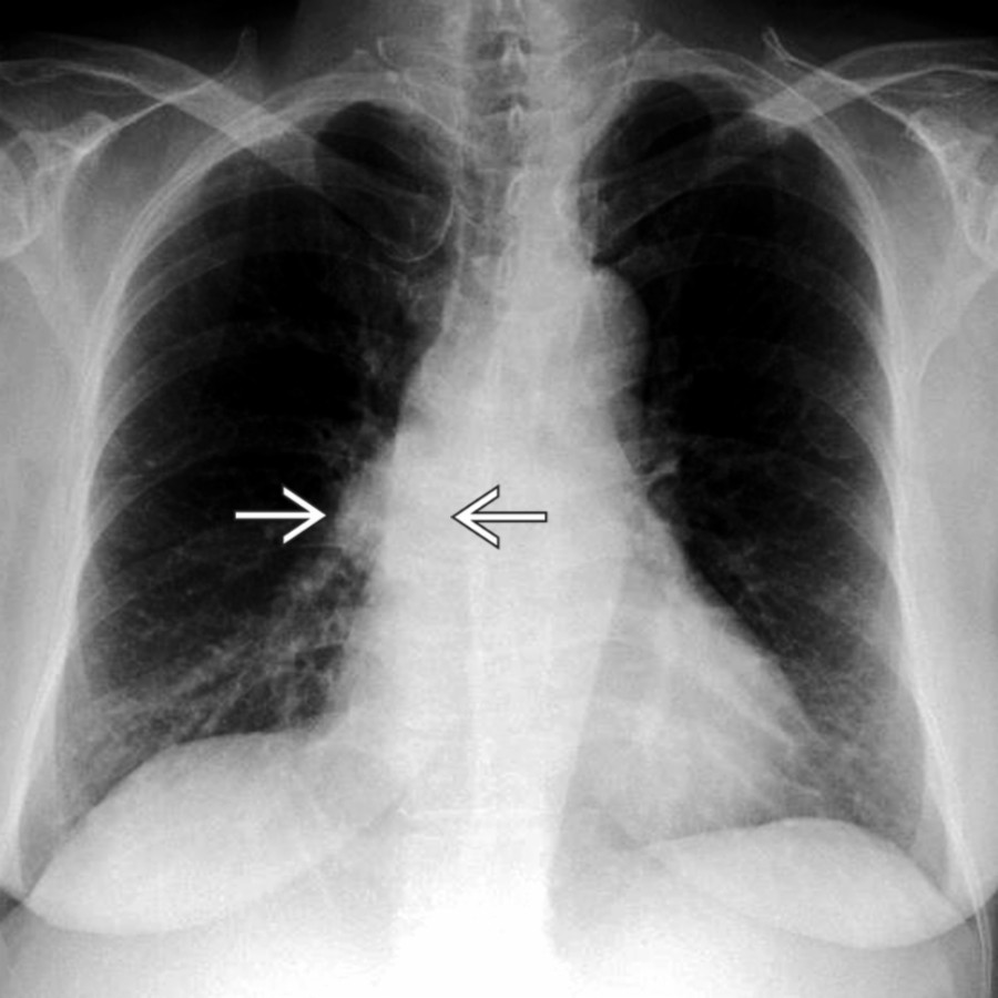 Frontal radiograph shows a rounded opacity superimposed upon the right heart border . On CT, this was found to represent a pericardial cyst.