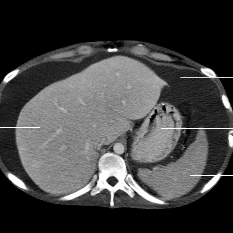 First of 4 axial CECT images of a middle-aged man with cirrhosis with delineation of the peritoneal spaces and reflections is shown. Ascites distends the peritoneal cavity in these images, allowing visualization of recesses and peritoneal reflections, which are not normally seen.