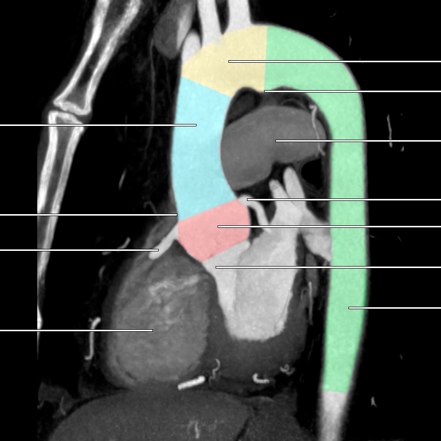 "Candy cane" oblique MPR depicts the segments of the thoracic aorta. The aortic root (red) extends from the aortic anulus to the sinotubular junction. The ascending aorta (blue) extends to the origin of the brachiocephalic trunk. The aortic arch (yellow) extends to the ligamentum arteriosum. The descending thoracic aorta (green) extends to the diaphragmatic hiatus, where it continues as the abdominal aorta. Note the smooth outpouching along the inferior surface of the aortic arch at the remnant of the ductus arteriosum. This is a normal ductus diverticulum and should not be mistaken for a traumatic aortic injury.