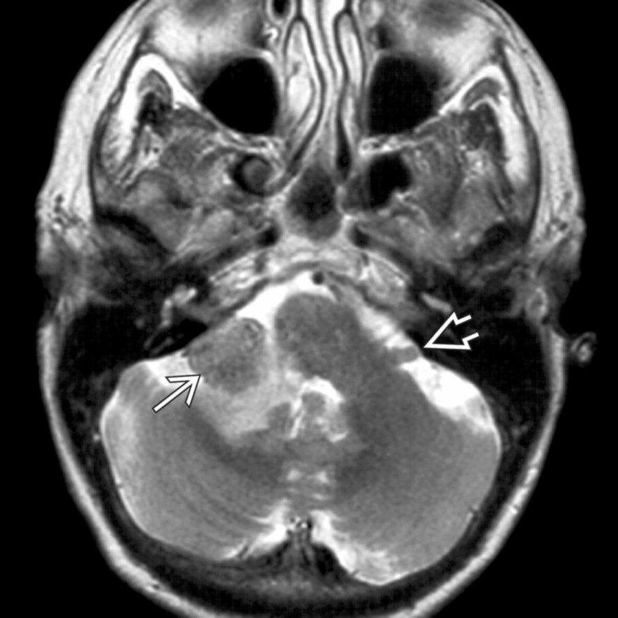 Axial T2WI MR demonstrates a right floccular metastasis  with associated high-signal cerebellar and brachium pontis edema. A normal left flocculus  is also seen.