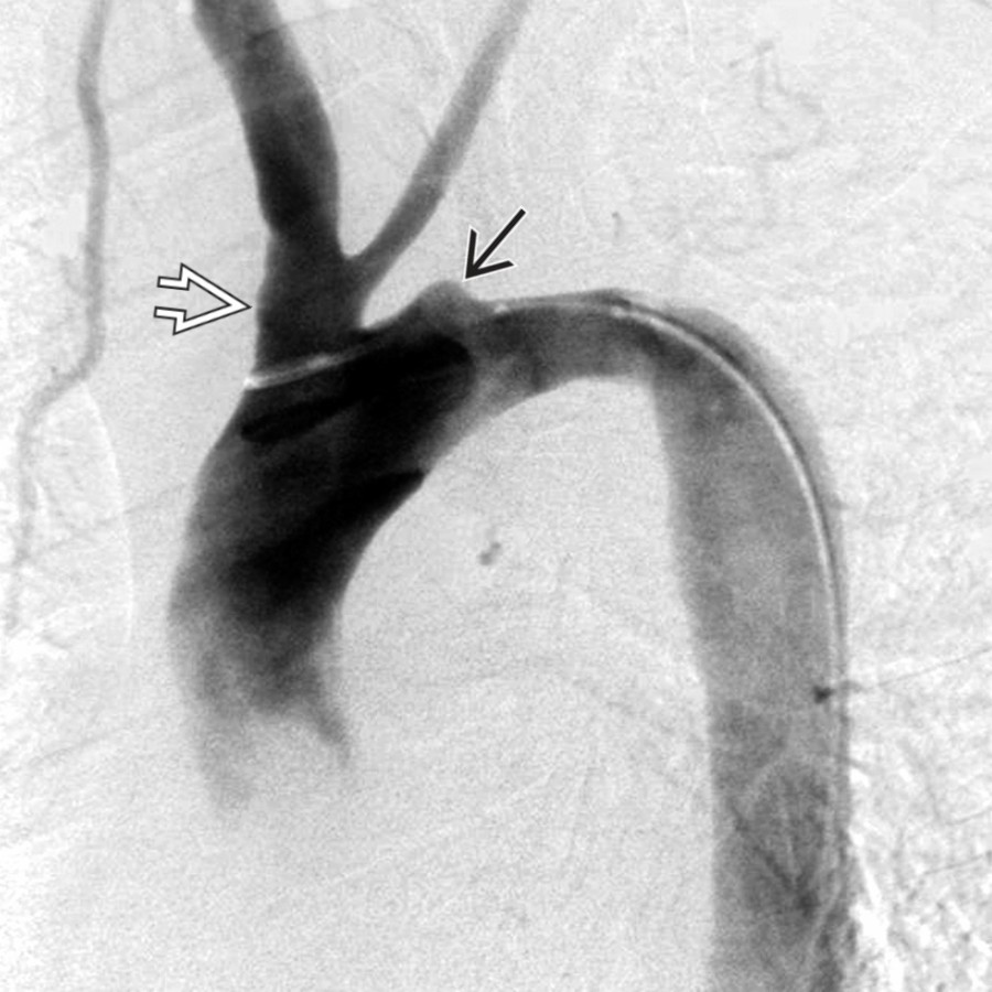 Sagittal oblique DSA in the same patient with TA shows occlusion of the left subclavian artery . Note the common origin  of the right brachiocephalic and left common carotid arteries.