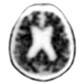 Axial F-18 florbetapir PET in the same patient demonstrates decreased gray-white differentiation indicating gray matter uptake  in some areas, concerning for Aβ deposition.