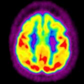 Axial F-18 FDG PET in an older adult with MCI shows AD findings of reduced metabolism in the posterior parietal  and frontal  cortices. Importantly, there is sparing of the sensorimotor region .