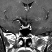 At follow-up 1 year later, coronal T1 C+ MR reveals a normal appearance to the pituitary gland with interval resolution of the postpartum physiologic enlargement.