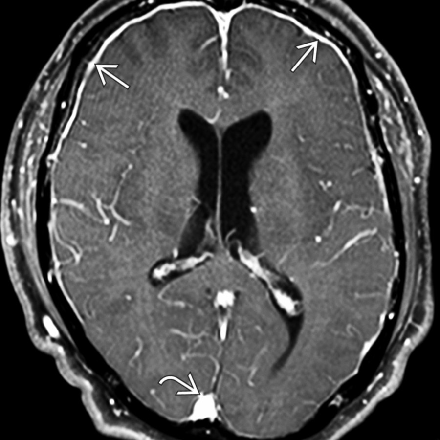 Axial T1 C+ FS MR in the same patient shows smooth, diffuse dura-arachnoid enhancement , and an engorged, outwardly convex superior sagittal sinus .