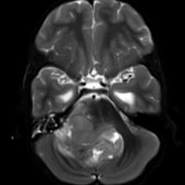 Axial T2 MR shows a heterogeneous mass in the 4th ventricle extending laterally through the left foramen of Luschka . This was a posterior fossa type A (PFA) ependymoma at resection. Ependymomas have a "toothpaste" propensity to extend through the 4th ventricular foramina.