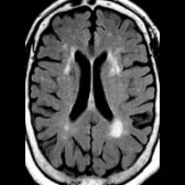 Axial FLAIR MR in a patient with vascular dementia shows confluent periventricular white matter hyperintensities  with volume loss.