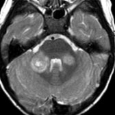 Axial T2 MR shows hyperintense lesions in the brachium pontis bilaterally, typical for demyelination. The right-sided lesion shows a targetoid  appearance. Enhancement of several lesions was present on postcontrast T1 images (not shown).